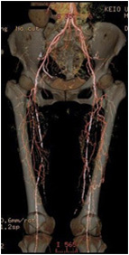 両下肢の閉塞性動脈硬化症の術前CT写真
            
