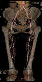 両下肢の閉塞性動脈硬化症の術前CT写真
            