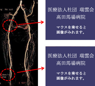 両下肢のバイパス術後